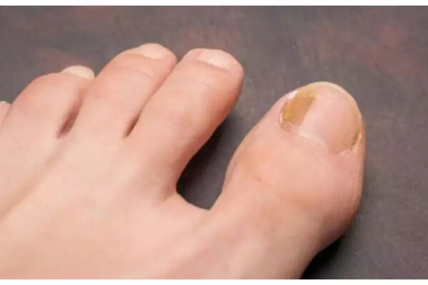 5 symptoms of Nail Cancer that can go unnoticed