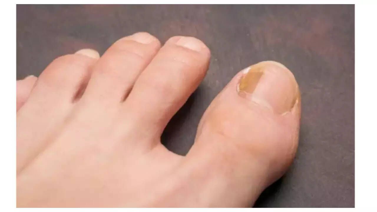 5 symptoms of Nail Cancer that can go unnoticed 5 symptoms of Nail Cancer that can go unnoticed